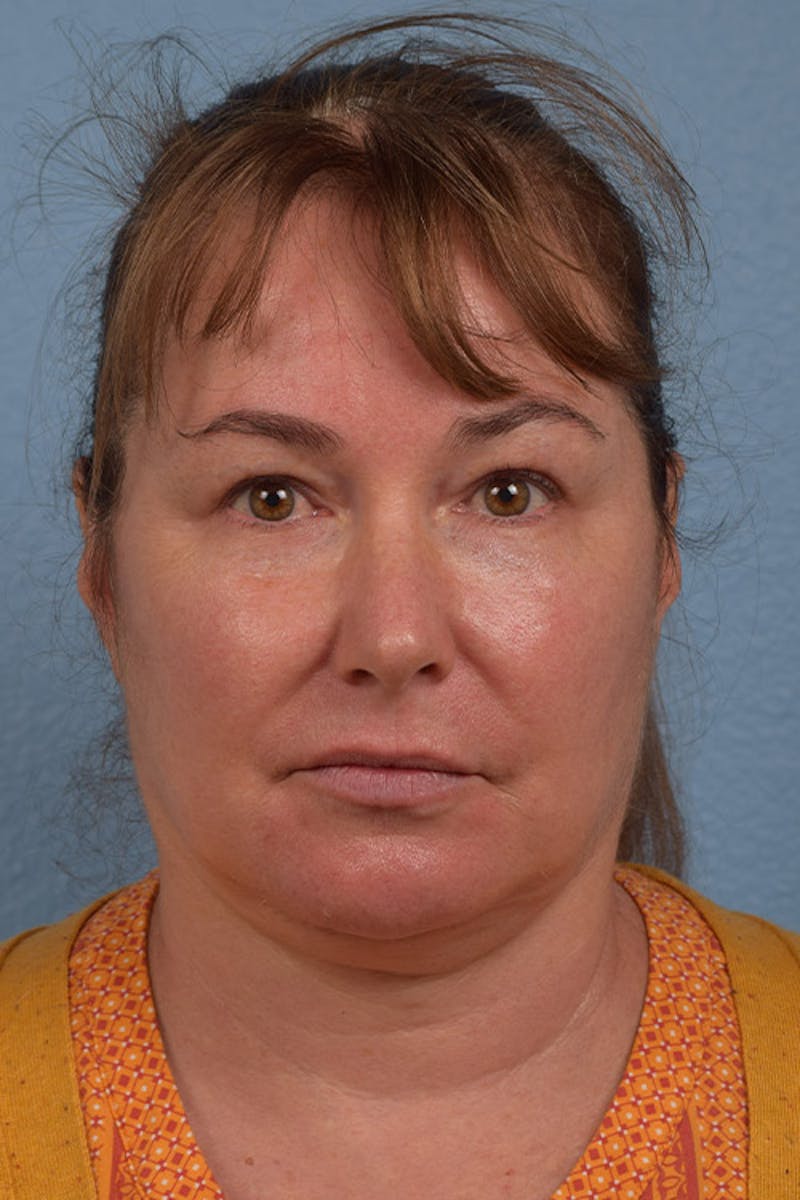 Facial Fillers Before & After Gallery - Patient 51538728 - Image 1