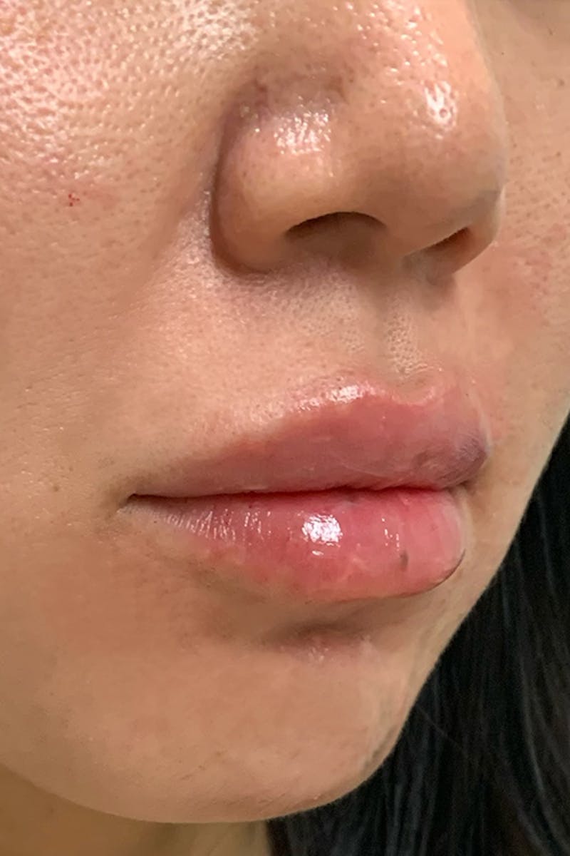 Lip Fillers Before & After Gallery - Patient 51538727 - Image 4