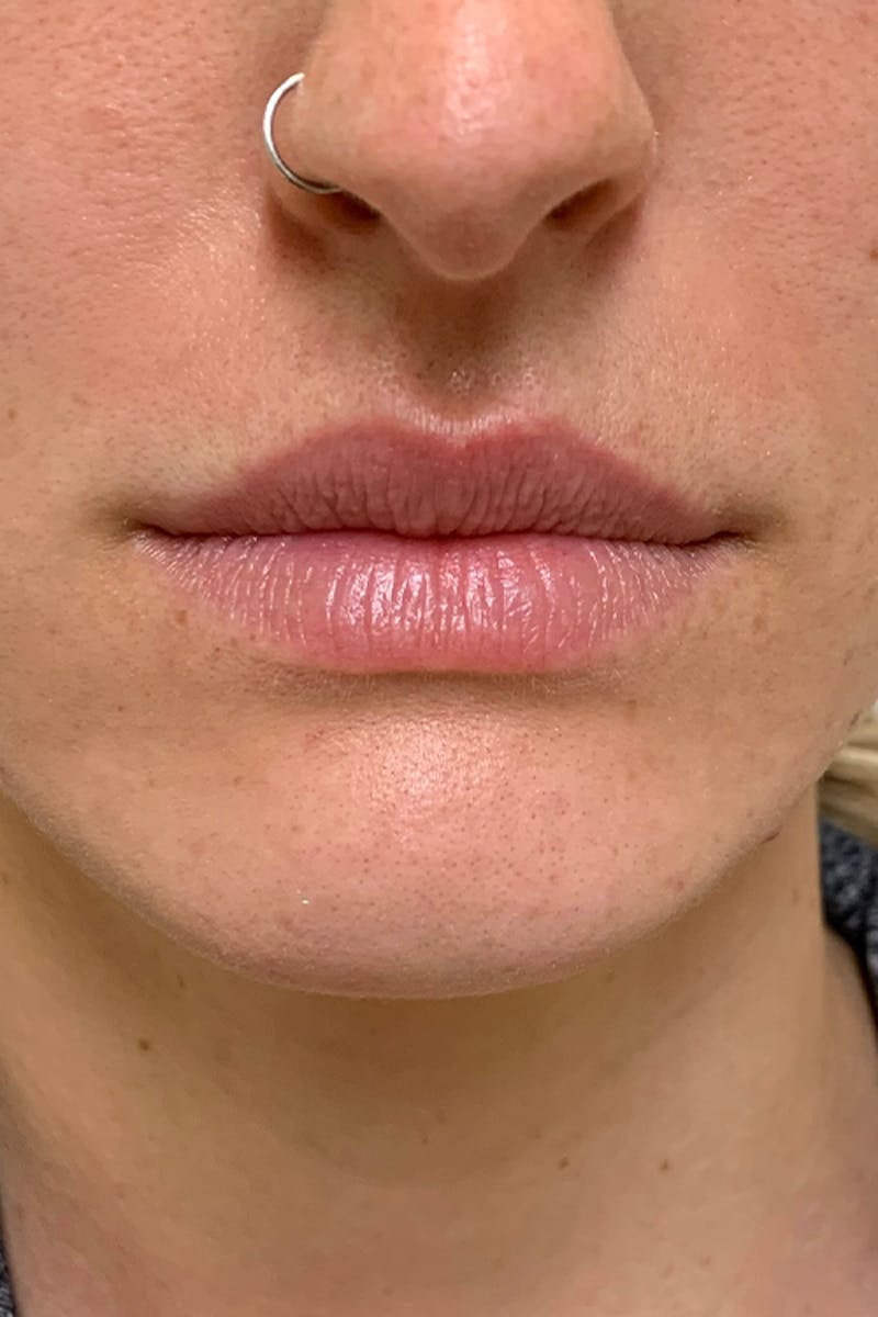 Lip Fillers Before & After Gallery - Patient 51538732 - Image 1