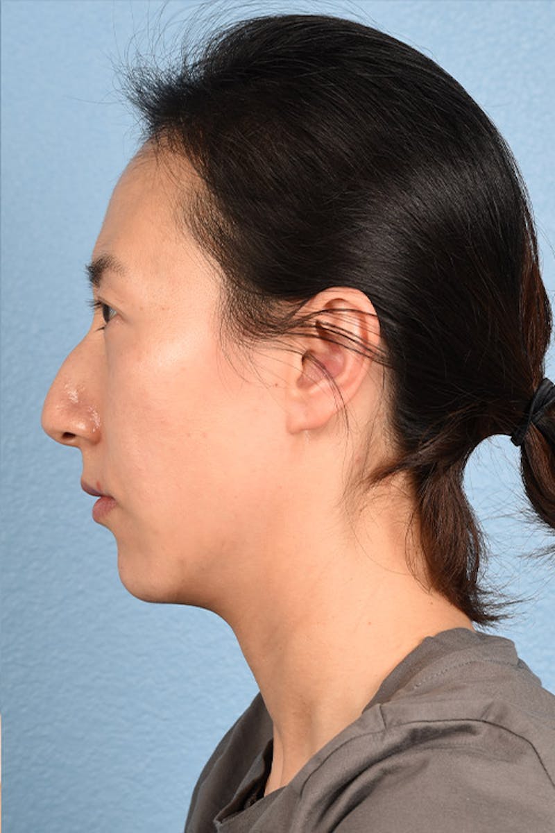 Thermage Flx Before & After Gallery - Patient 51538736 - Image 3