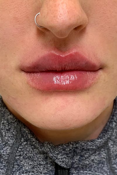 Lip Fillers Before & After Gallery - Patient 51538732 - Image 2