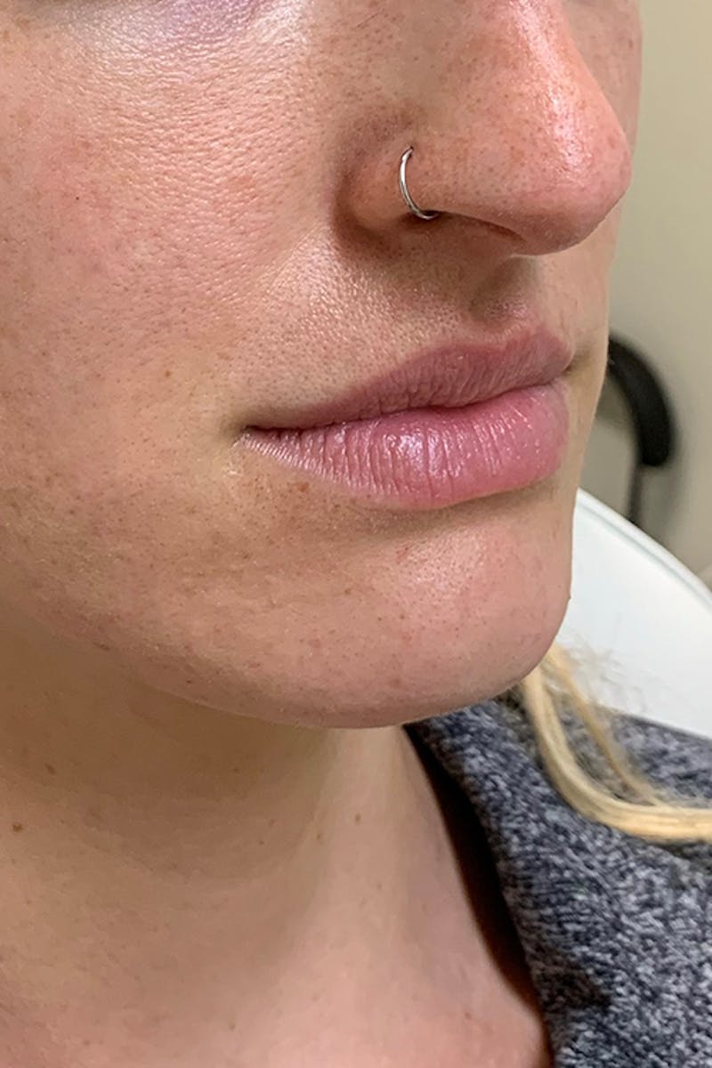 Lip Fillers Before & After Gallery - Patient 51538732 - Image 3