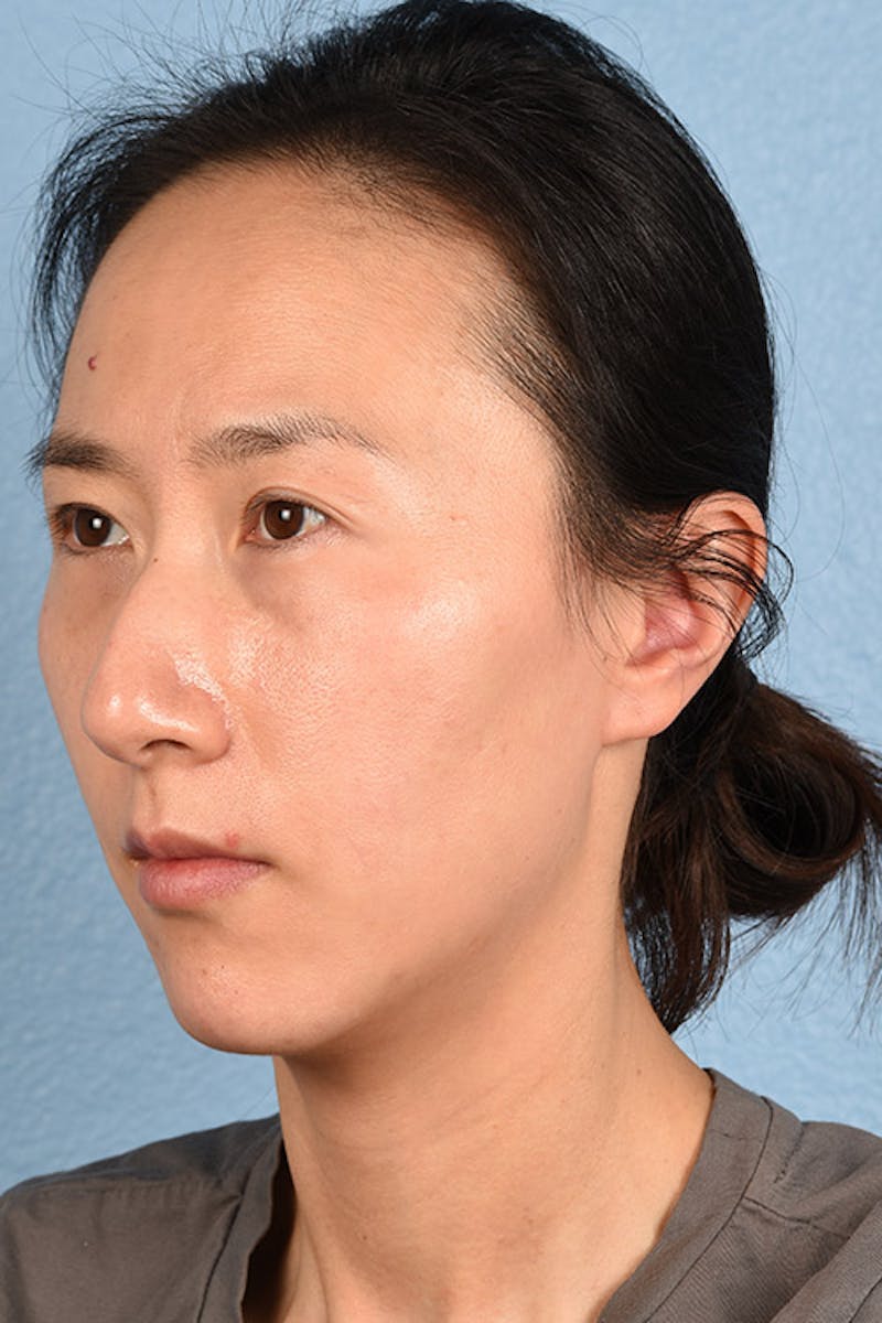 Thermage Flx Before & After Gallery - Patient 51538736 - Image 5