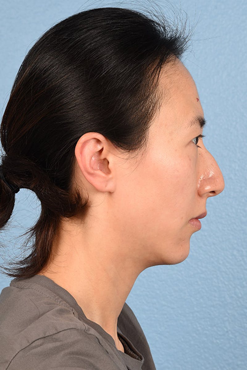 Thermage Flx Before & After Gallery - Patient 51538736 - Image 7