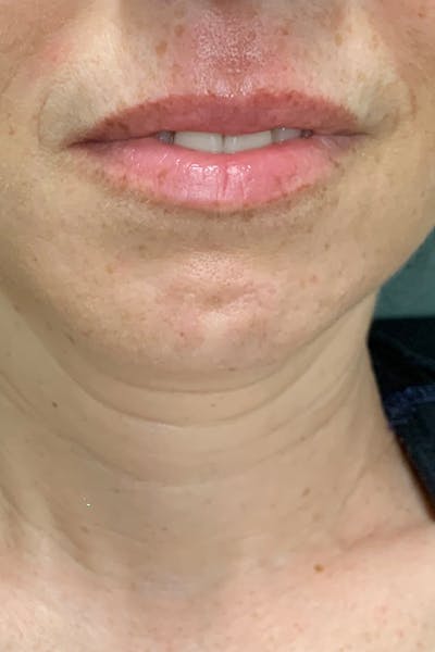 Lip Fillers Before & After Gallery - Patient 51538737 - Image 1