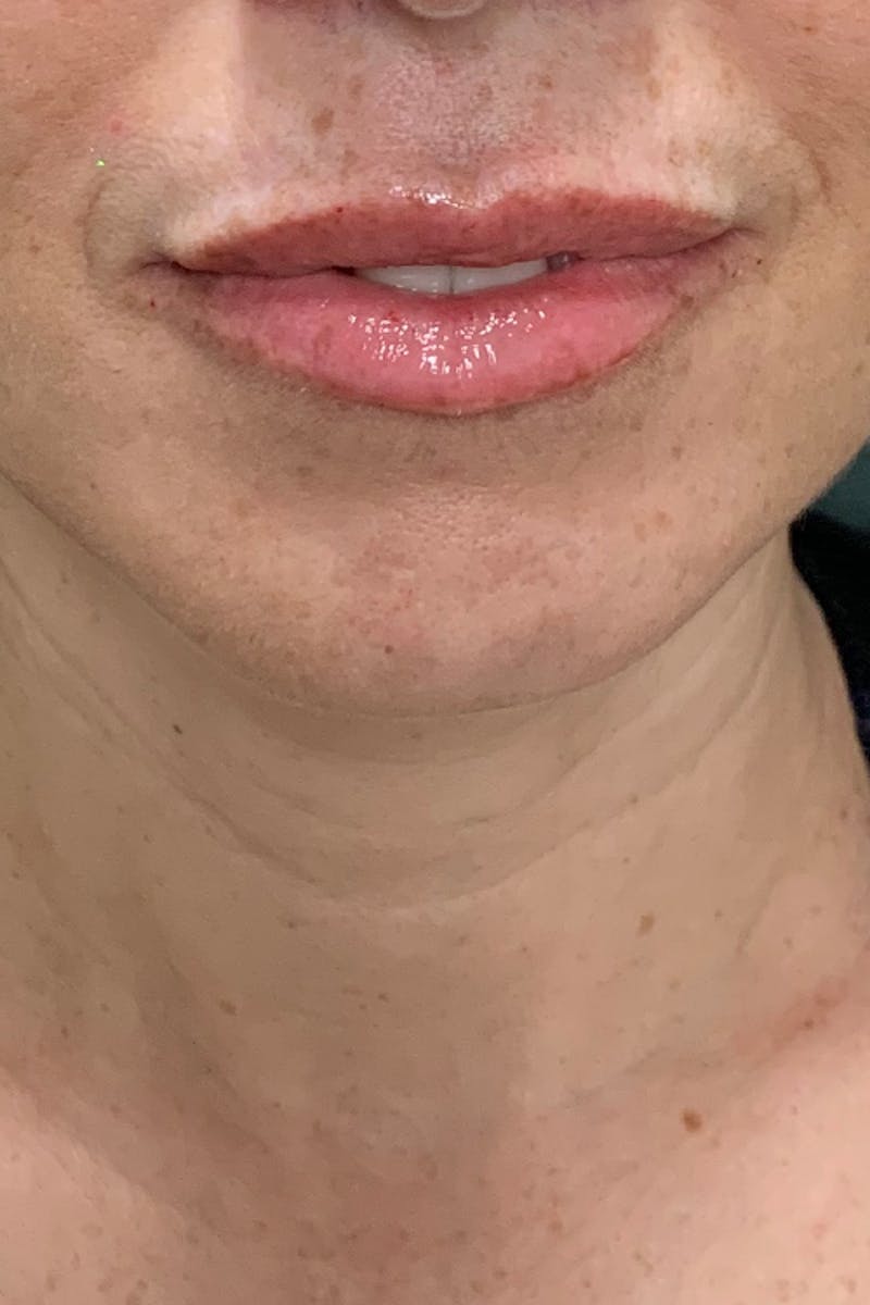 Lip Fillers Before & After Gallery - Patient 51538737 - Image 2