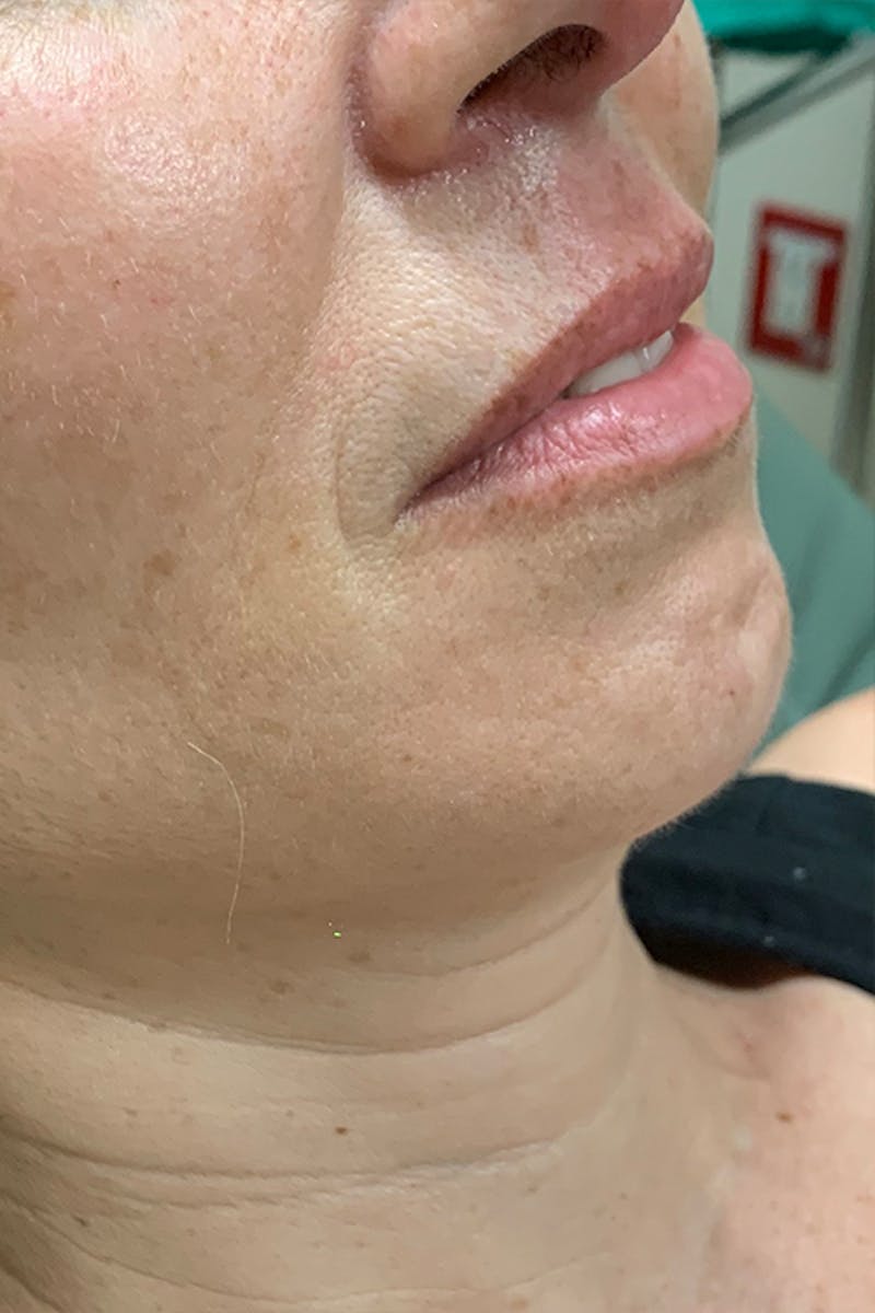Lip Fillers Before & After Gallery - Patient 51538737 - Image 3