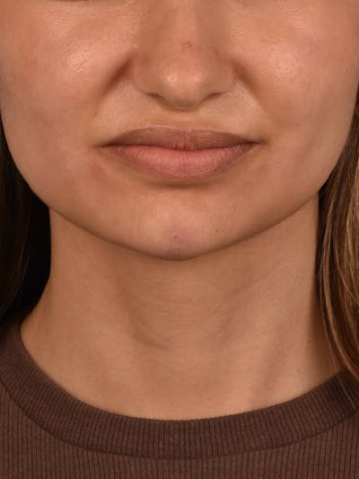 Injectables Before & After Gallery - Patient 51538735 - Image 2