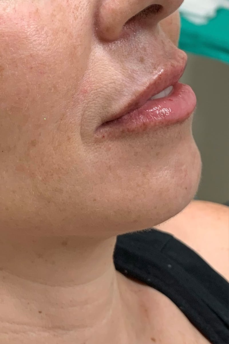Lip Fillers Before & After Gallery - Patient 51538737 - Image 4