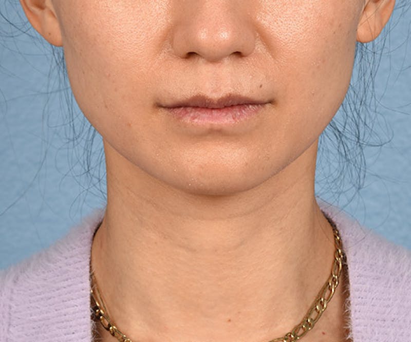 Thermage Flx Before & After Gallery - Patient 51538743 - Image 1