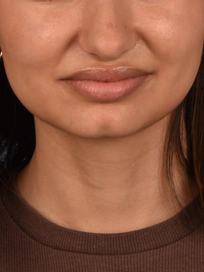 Facial Fillers Before & After Gallery - Patient 51538740 - Image 1