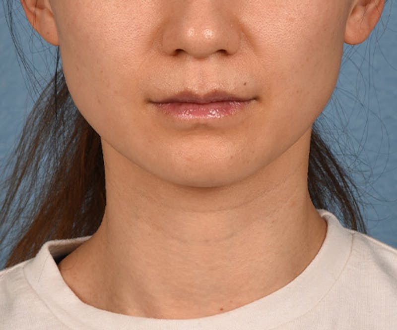 Thermage Flx Before & After Gallery - Patient 51538743 - Image 2