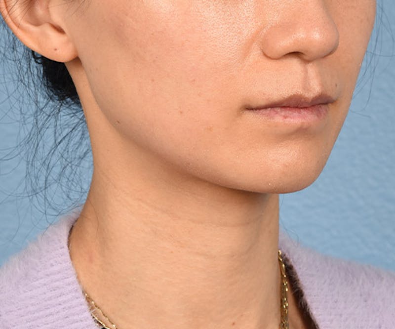 Thermage Flx Before & After Gallery - Patient 51538743 - Image 3