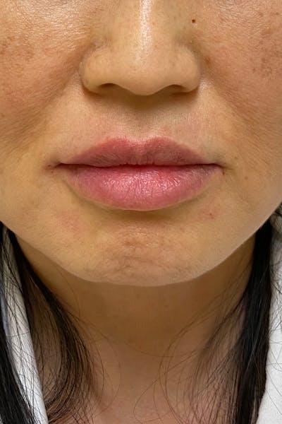 Lip Fillers Before & After Gallery - Patient 51538741 - Image 2