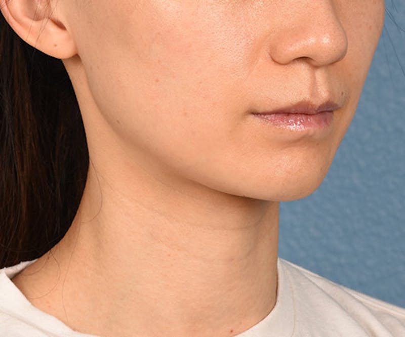 Thermage Flx Before & After Gallery - Patient 51538743 - Image 4