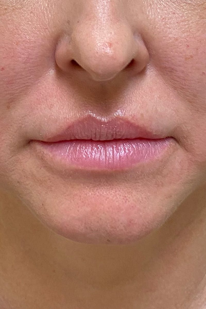 Lip Fillers Before & After Gallery - Patient 51538744 - Image 1