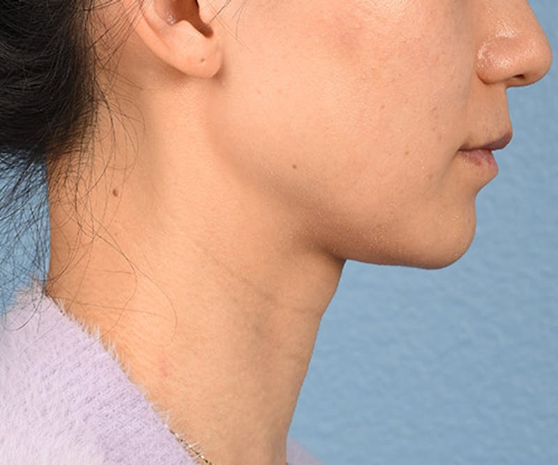 Thermage Flx Before & After Gallery - Patient 51538743 - Image 5