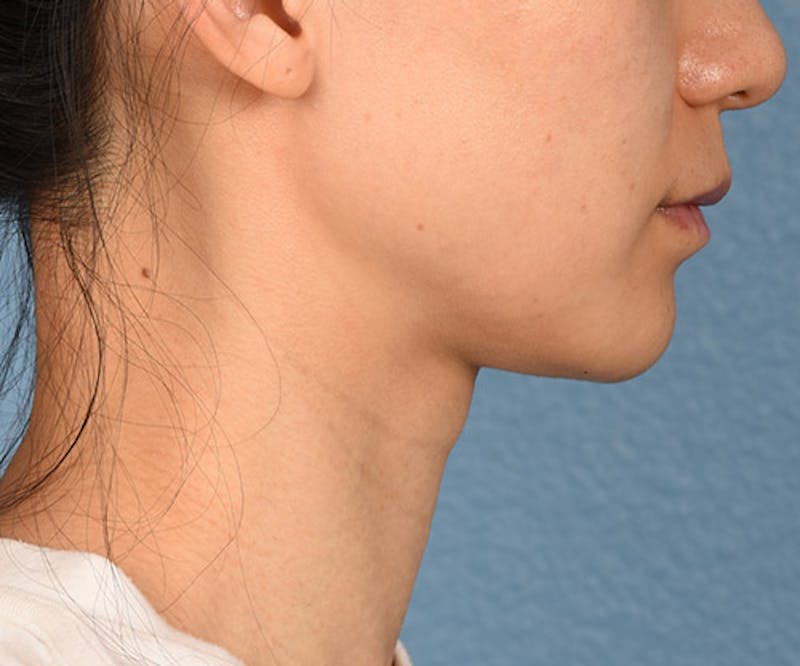 Thermage Flx Before & After Gallery - Patient 51538743 - Image 6