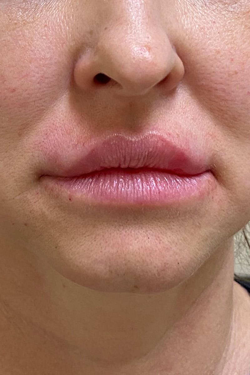 Lip Fillers Before & After Gallery - Patient 51538744 - Image 2