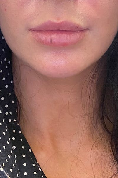 Lip Fillers Before & After Gallery - Patient 51538747 - Image 1