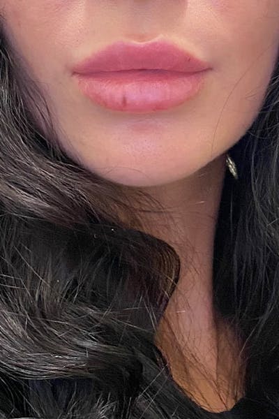 Lip Fillers Before & After Gallery - Patient 51538747 - Image 2