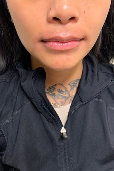 Lip Fillers Before & After Gallery - Patient 51538749 - Image 1