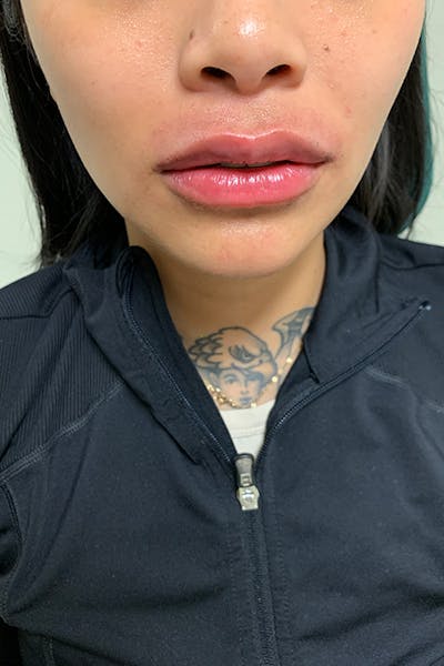 Lip Fillers Before & After Gallery - Patient 51538749 - Image 2