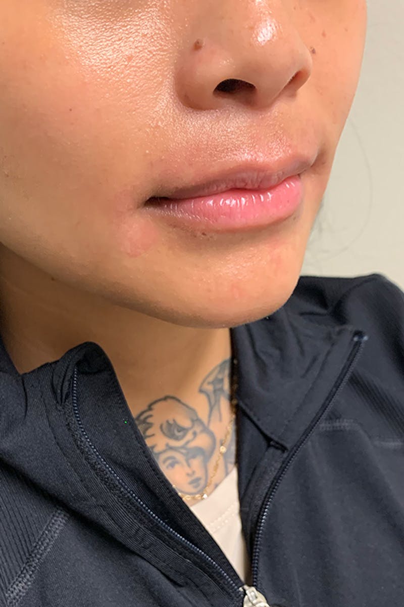 Lip Fillers Before & After Gallery - Patient 51538749 - Image 3