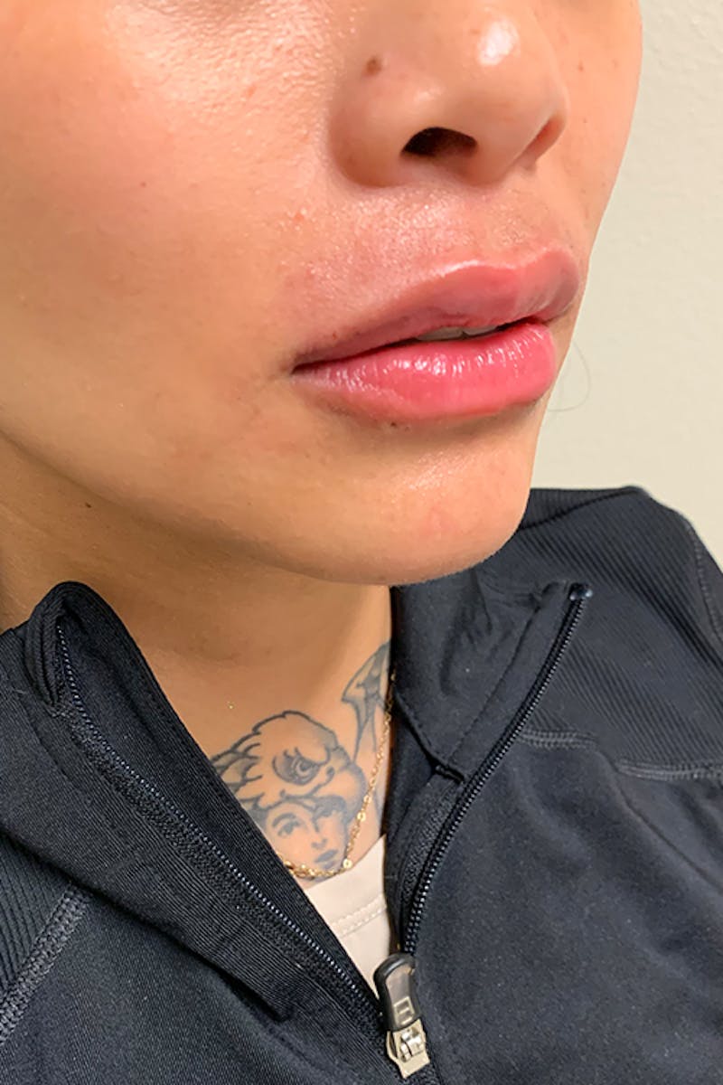 Lip Fillers Before & After Gallery - Patient 51538749 - Image 4