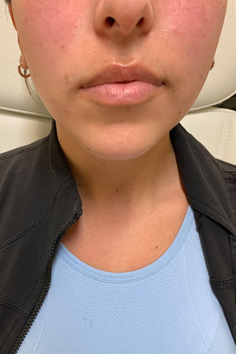 Lip Fillers Before & After Gallery - Patient 51538754 - Image 1