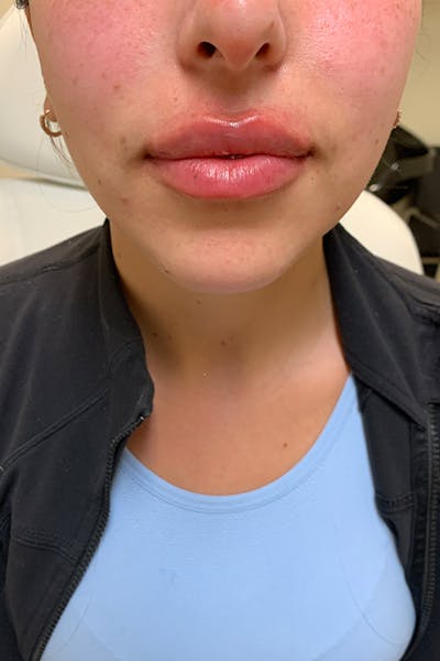 Lip Fillers Before & After Gallery - Patient 51538754 - Image 2