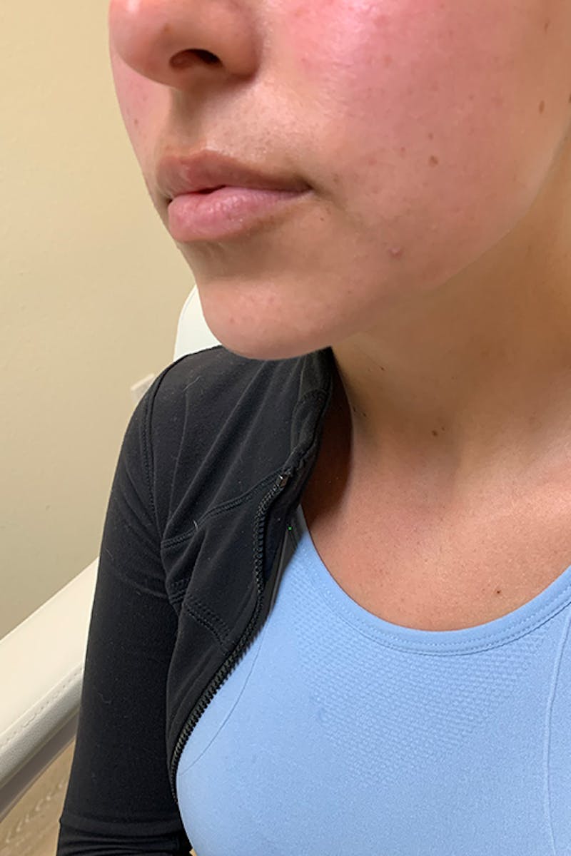 Lip Fillers Before & After Gallery - Patient 51538754 - Image 3