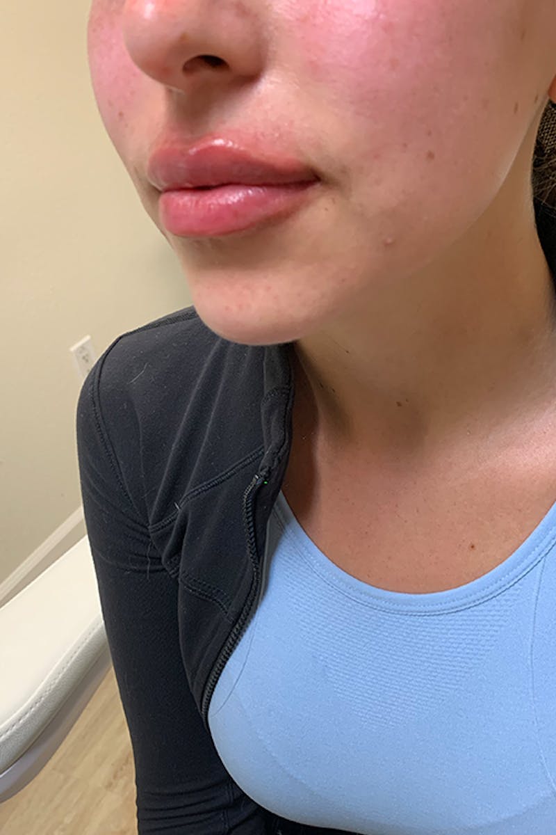 Lip Fillers Before & After Gallery - Patient 51538754 - Image 4
