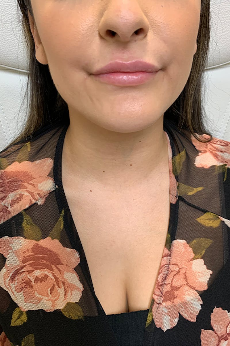 Lip Fillers Before & After Gallery - Patient 51538758 - Image 1