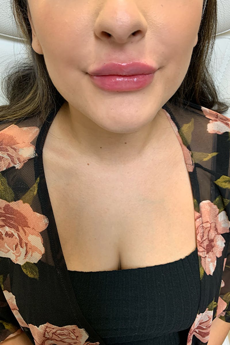 Lip Fillers Before & After Gallery - Patient 51538758 - Image 2