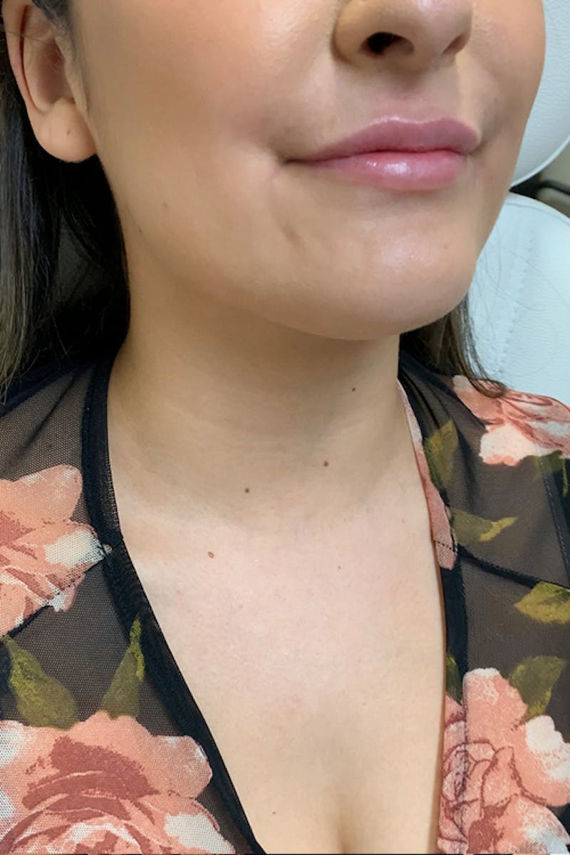 Lip Fillers Before & After Gallery - Patient 51538758 - Image 3