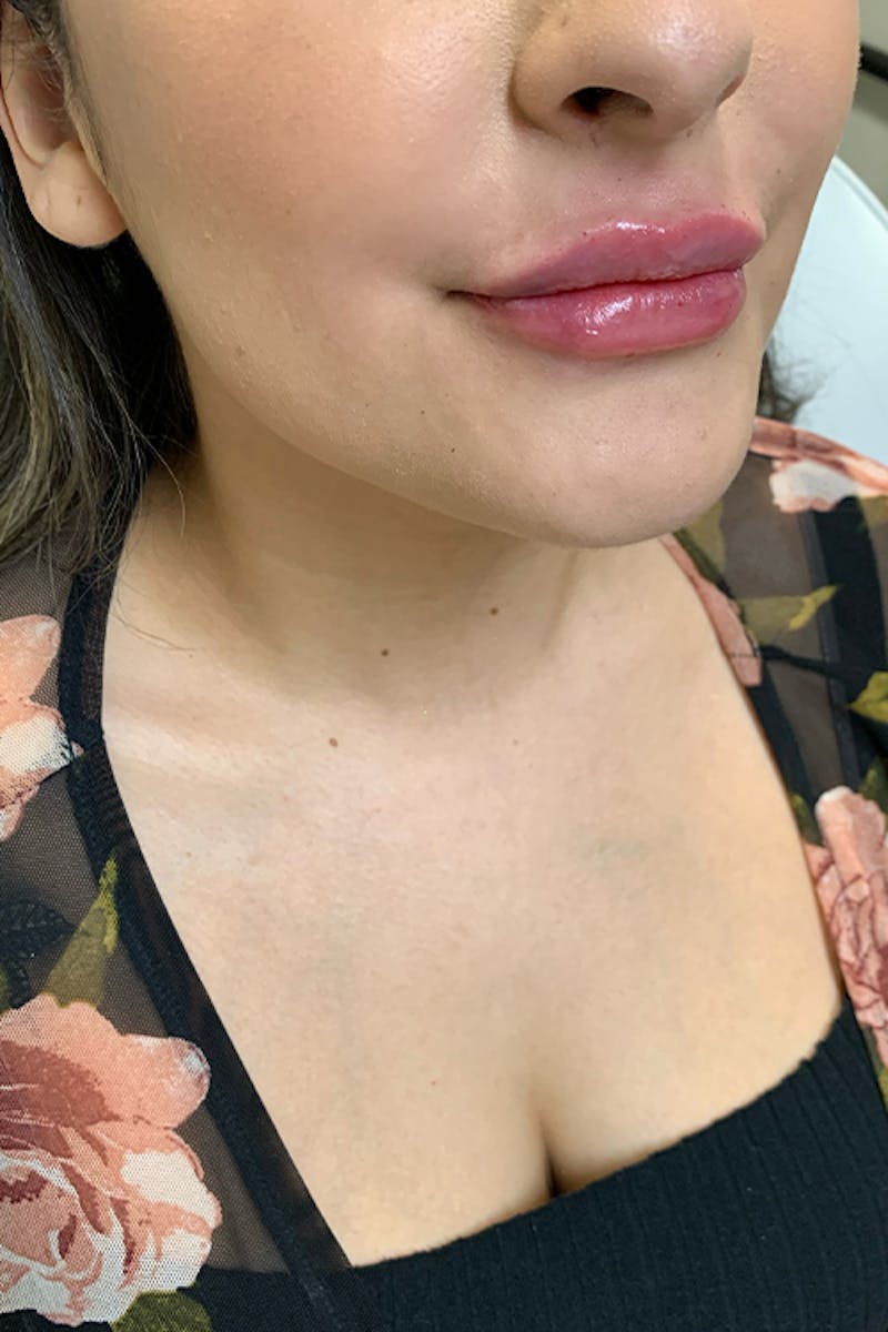 Lip Fillers Before & After Gallery - Patient 51538758 - Image 4