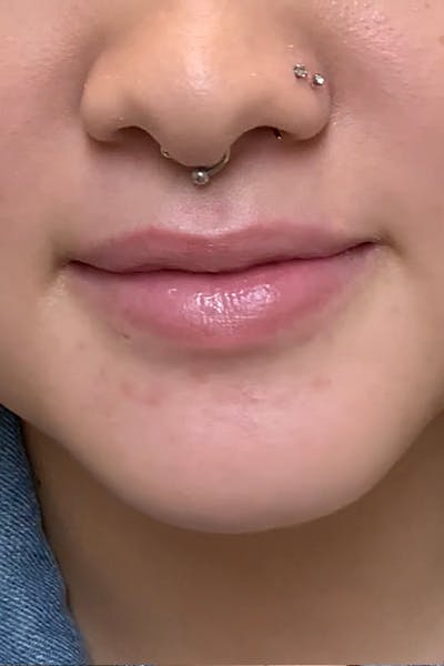Lip Fillers Before & After Gallery - Patient 51538759 - Image 1