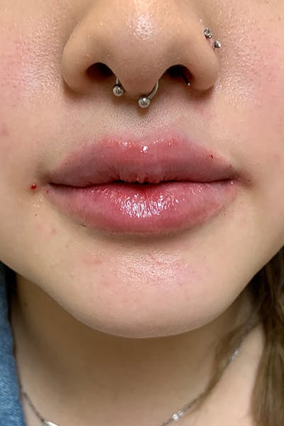 Lip Fillers Before & After Gallery - Patient 51538759 - Image 2