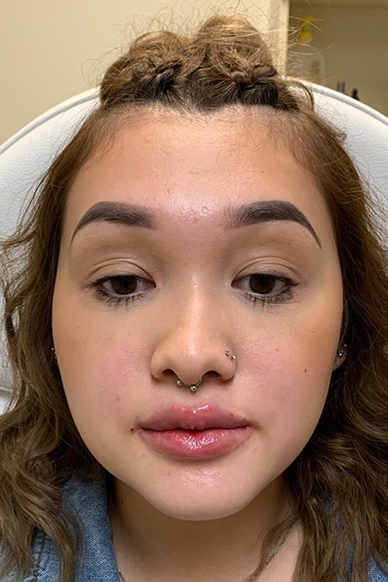 Lip Fillers Before & After Gallery - Patient 51538759 - Image 4