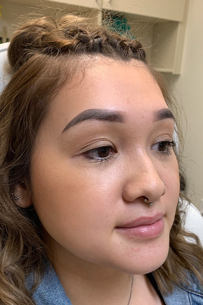 Lip Fillers Before & After Gallery - Patient 51538759 - Image 5