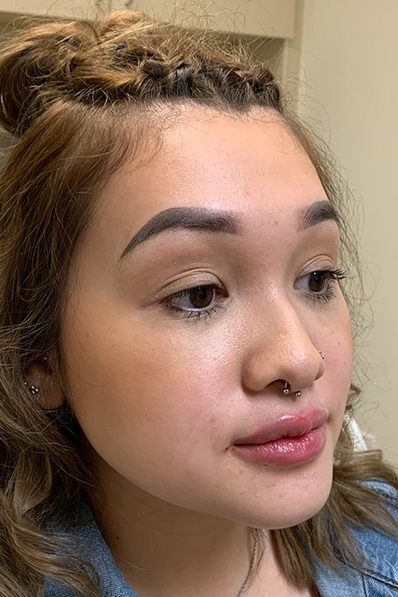 Lip Fillers Before & After Gallery - Patient 51538759 - Image 6