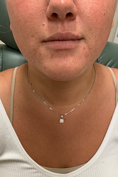 Lip Fillers Before & After Gallery - Patient 51538761 - Image 1