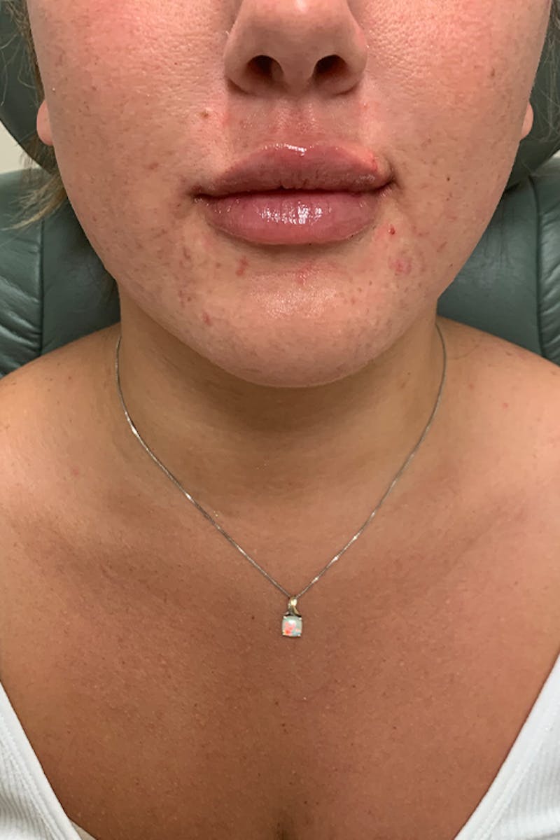 Lip Fillers Before & After Gallery - Patient 51538761 - Image 2