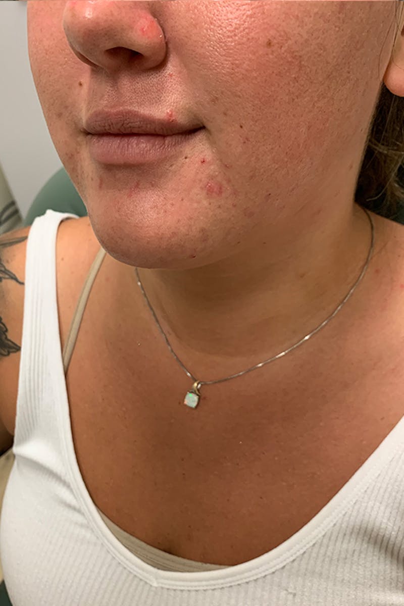 Lip Fillers Before & After Gallery - Patient 51538761 - Image 3