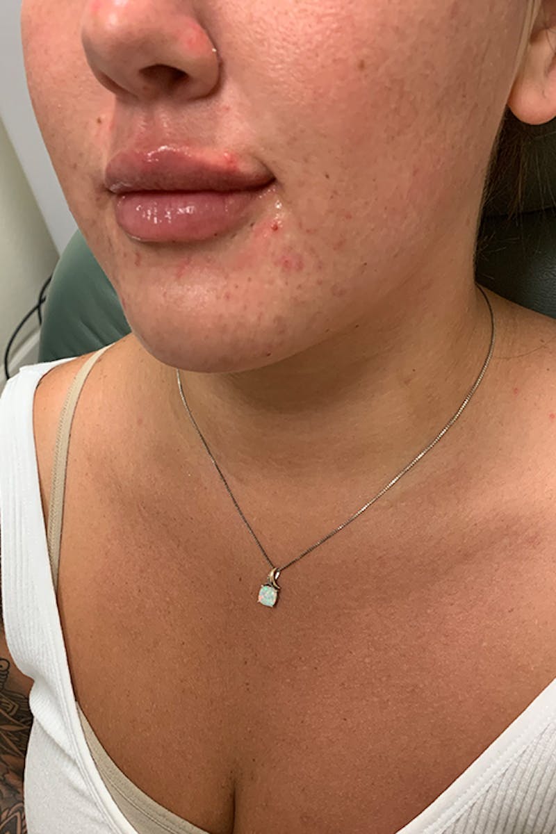 Lip Fillers Before & After Gallery - Patient 51538761 - Image 4
