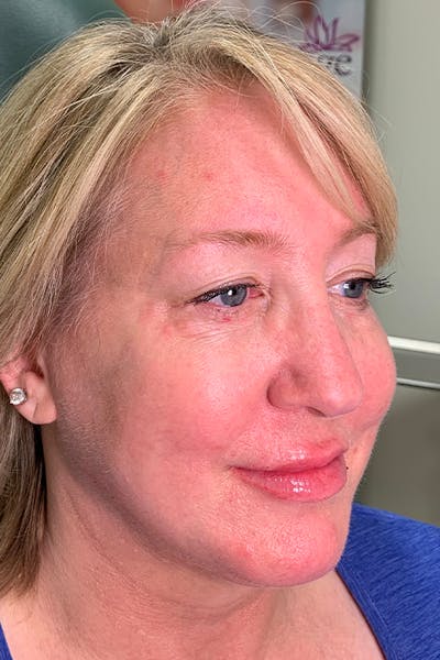 Lip Fillers Before & After Gallery - Patient 51538762 - Image 2