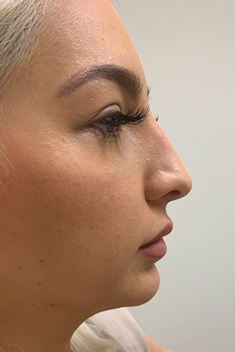 Non-Surgical Rhinoplasty Before & After Gallery - Patient 51538763 - Image 1