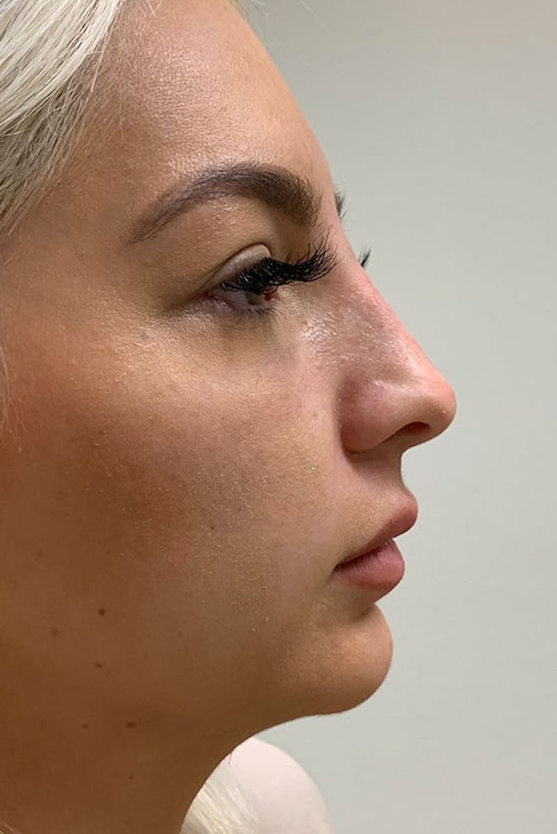 Non-Surgical Rhinoplasty Before & After Gallery - Patient 51538763 - Image 2