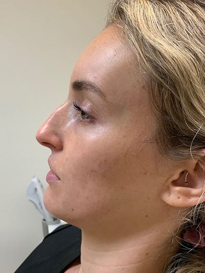Non-Surgical Rhinoplasty Before & After Gallery - Patient 51538765 - Image 1